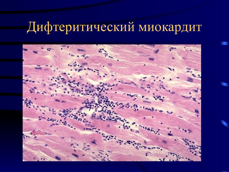 Менингококковая инфекция патологическая анатомия презентация