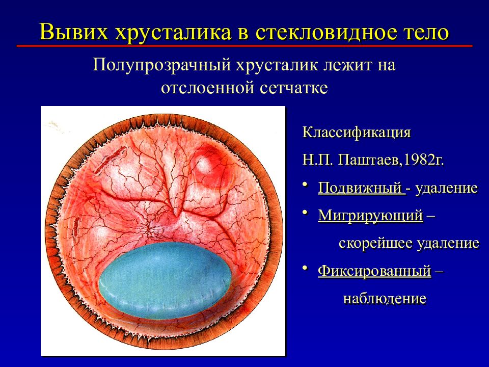 Хрусталик стекловидное. Вывих хрусталика в стекловидное тело. Вывих и подвывих хрусталика. Люксация хрусталика в стекловидное тело.