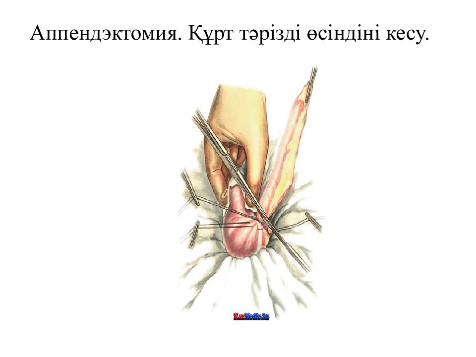 Абсцесс после аппендэктомии