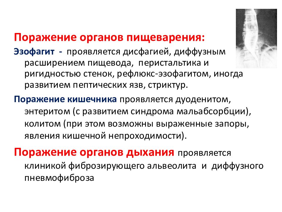 Склеродермия инвалидность. Конституциональные проявления системной склеродермии. Продолжительность жизни при системной склеродермии. Поражение легких при склеродермии.