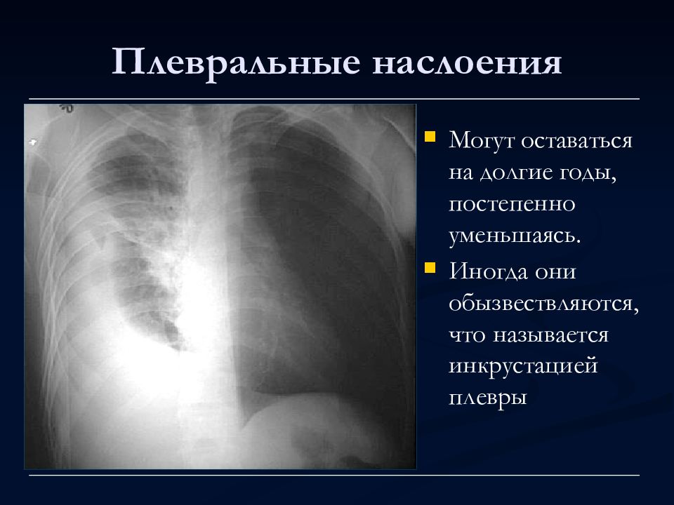 Инкрустация плевры рентгенологическая картина