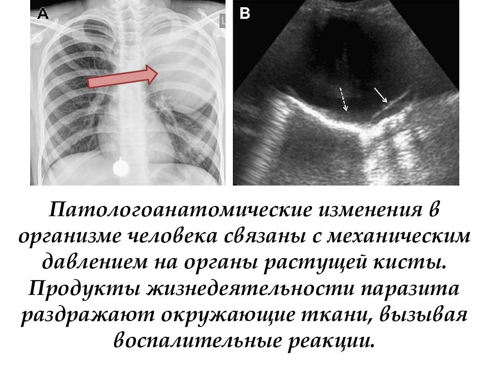 Эхинококкоз легких презентация