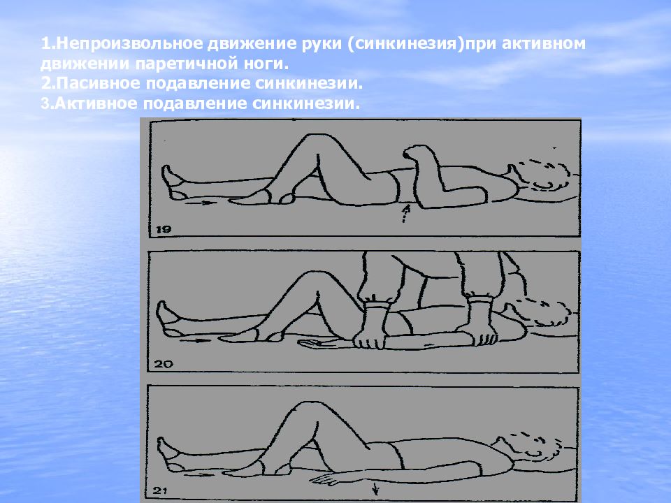 Непроизвольные движения. Координаторные синкинезии. Непроизвольные движения в конечностях. Патологические синкинезии. Непроизвольные содружественные движения.