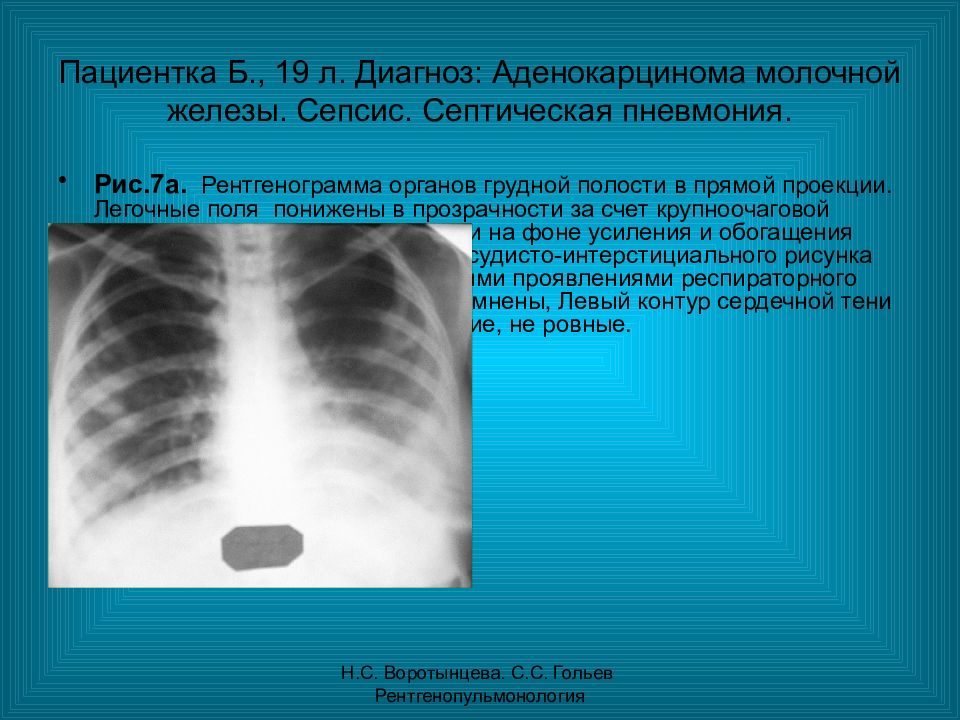 Л диагноз. Рентген септической метастатической пневмонии.. Септическая пневмония рентген. Ассептическая пневмония на рентгене.