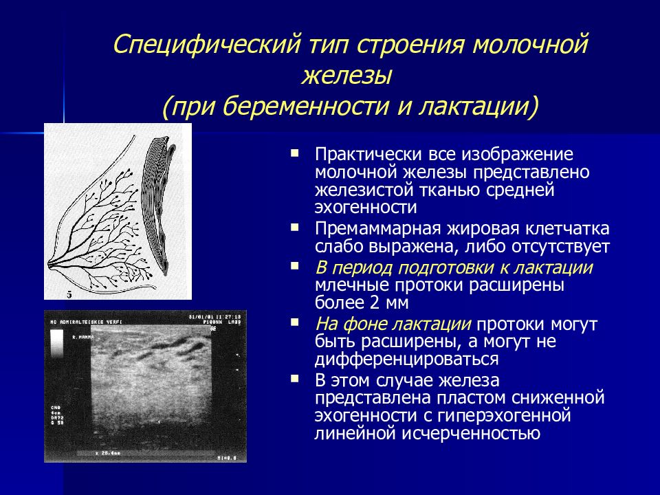 Диффузный фам молочных желез что это. Эктазия протоков молочной железы. Млечные протоки молочной железы. Закупорка протоков молочной железы. Норма млечных протоков по УЗИ.