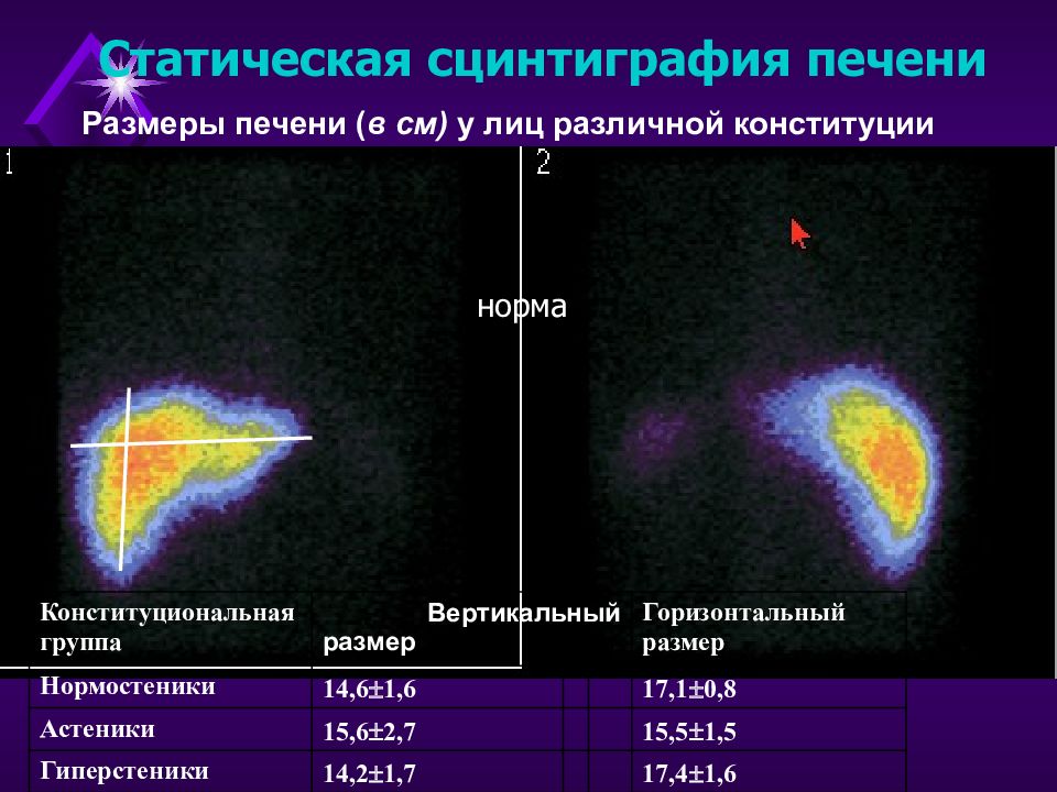 Что такое сцинтиграфия