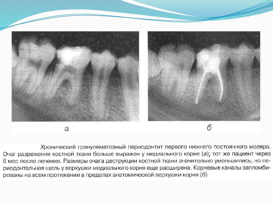 Хронический фиброзный периодонтит лечение. Периодонтит зуба рентген. Гранулирующий периодонтит рентген. Периодонтит 6 зуба сверху.