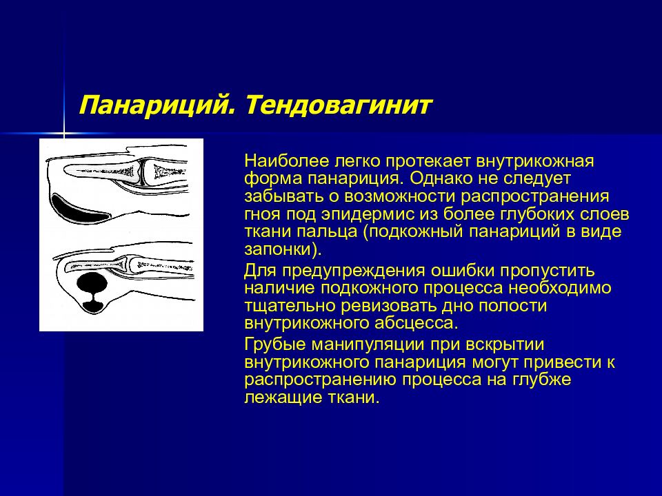 Виды панариция