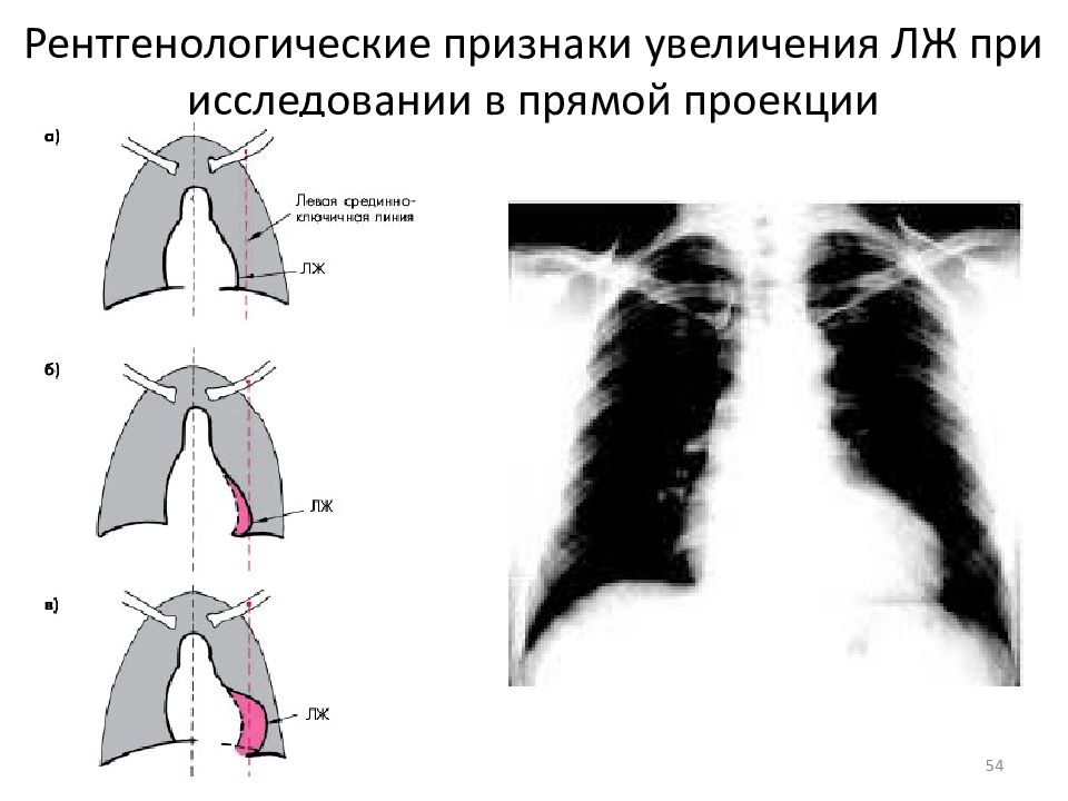 Признаки увеличенного. Рентгенологические проекции. Рентгенологические признаки. Рентгенологические признаки увеличения лж. Рентгенограмма стенозе левого атриовентрикулярного отверстия.