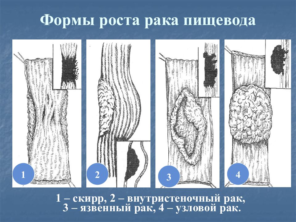 Рак пищевода презентация