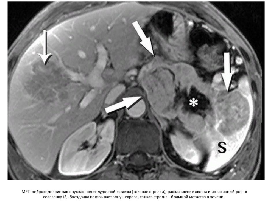 Рак печени и поджелудочной железы презентация