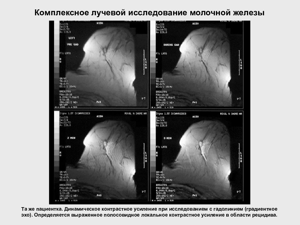 Лучевая диагностика заболеваний молочных желез. Диагностика молочной железы. Методы лучевого исследования молочных желез. Динамическое контрастное усиление. Методика исследования молочных желез.