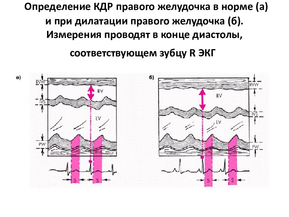 Особенности эха. КДР КСР правого желудочка норма. КДР левого желудочка норма. КДР левого желудочка норма у ребенка. КДР норма.