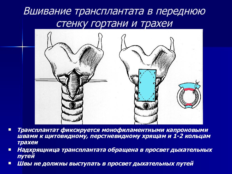 Стенки гортани. Анатомия и физиология гортани и трахеи.