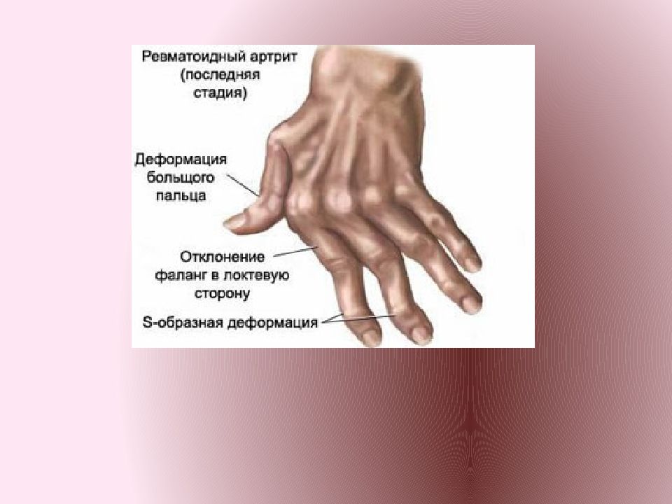 Фото ревматоидного артрита у женщин