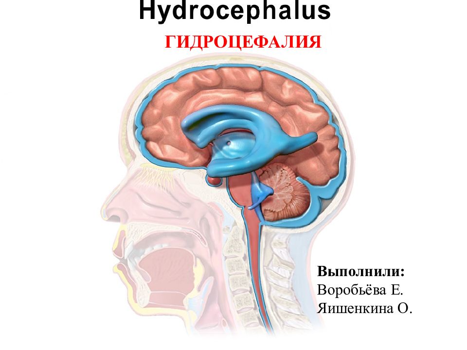 Гидроцефалия мозга у взрослого