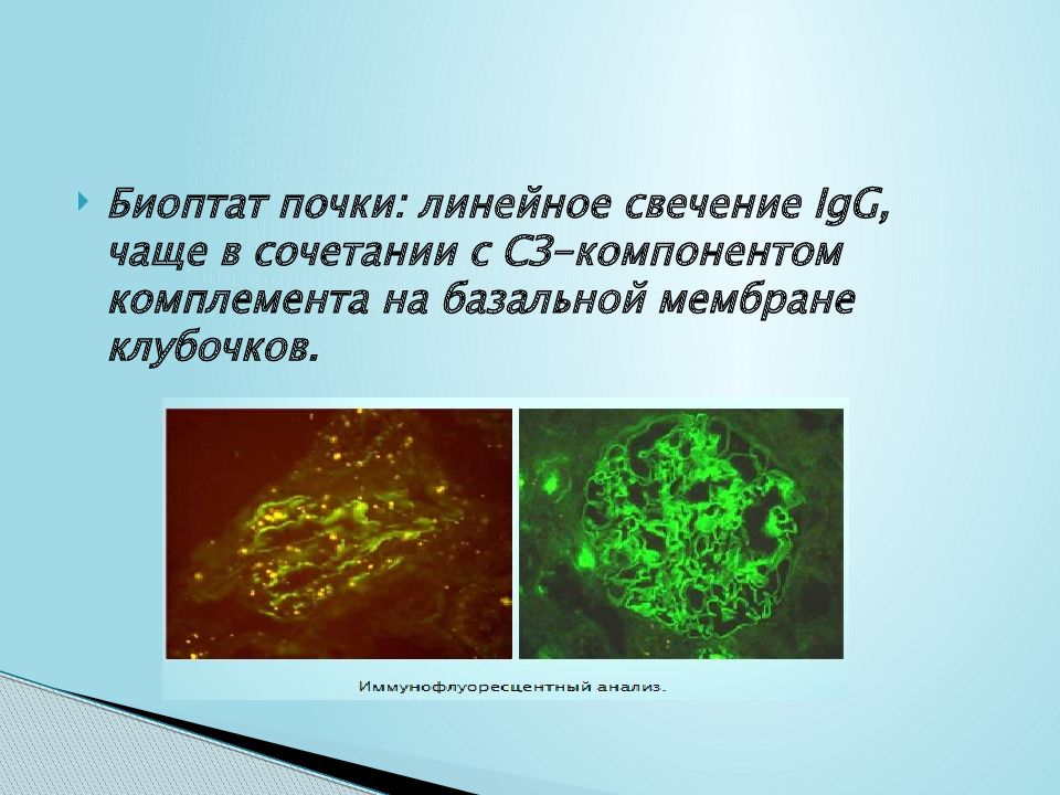 Синдром гудпасчера презентация