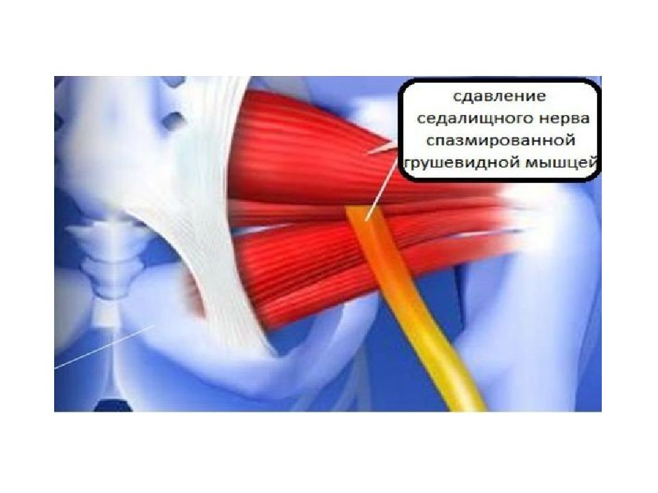 Седалищный нерв презентация