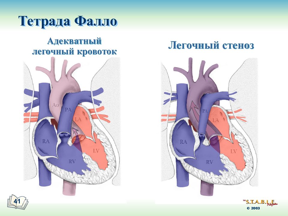 Тетрада фалло лечение