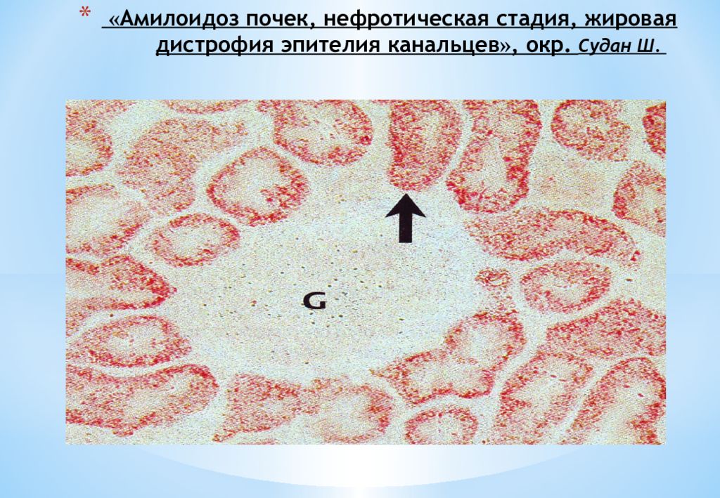 Амилоидоз почек. Жировая дистрофия почек микропрепарат. Амилоидная дистрофия почки микропрепарат. Патология канальцев почек.