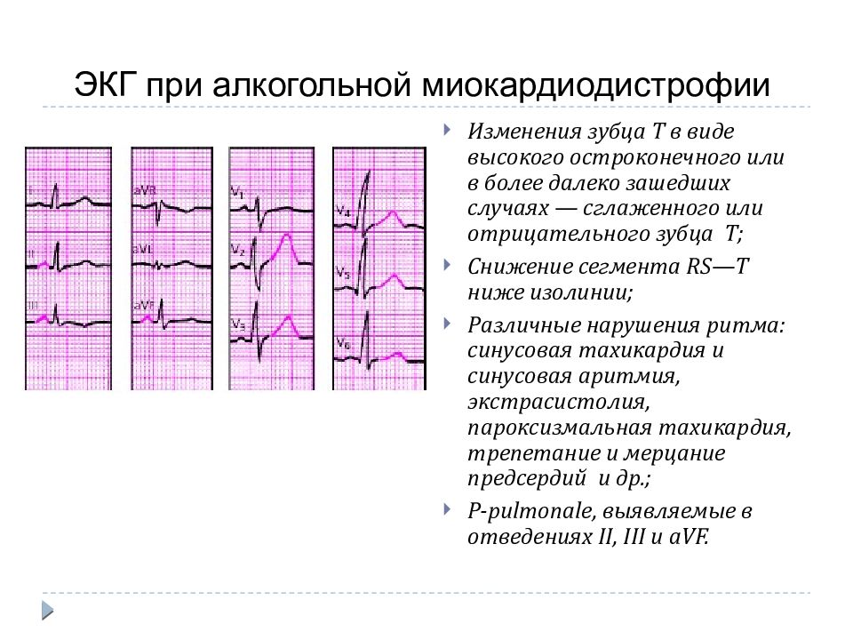 Экг при тиреотоксикозе картинки