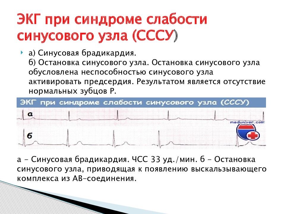 Синдром слабости синусового узла код мкб 10. Синдром слабости синусового узла СССУ. Синдром слабости синусового узла ЭКГ. Критерии синдрома слабости синусового узла.