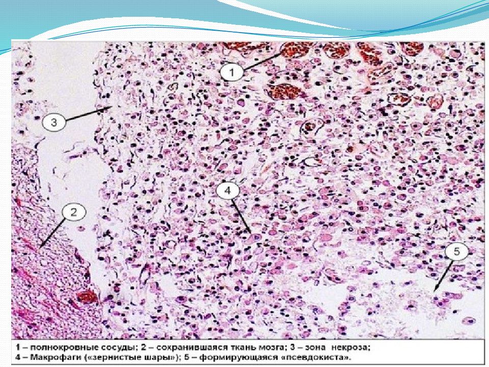 Кровоизлияние в мозг микроскопическая картина