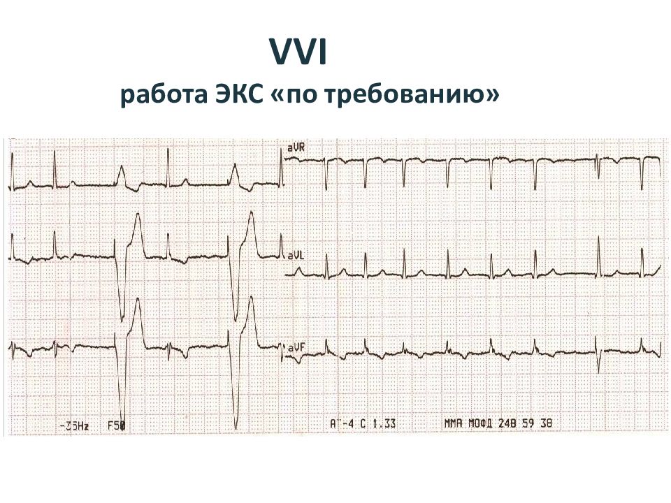 Режимы работы экс. Экс на работе. Экс в режиме VVI. Электрокардиостимуляция. Электрокардиостимуляция на догоспитальном этапе.