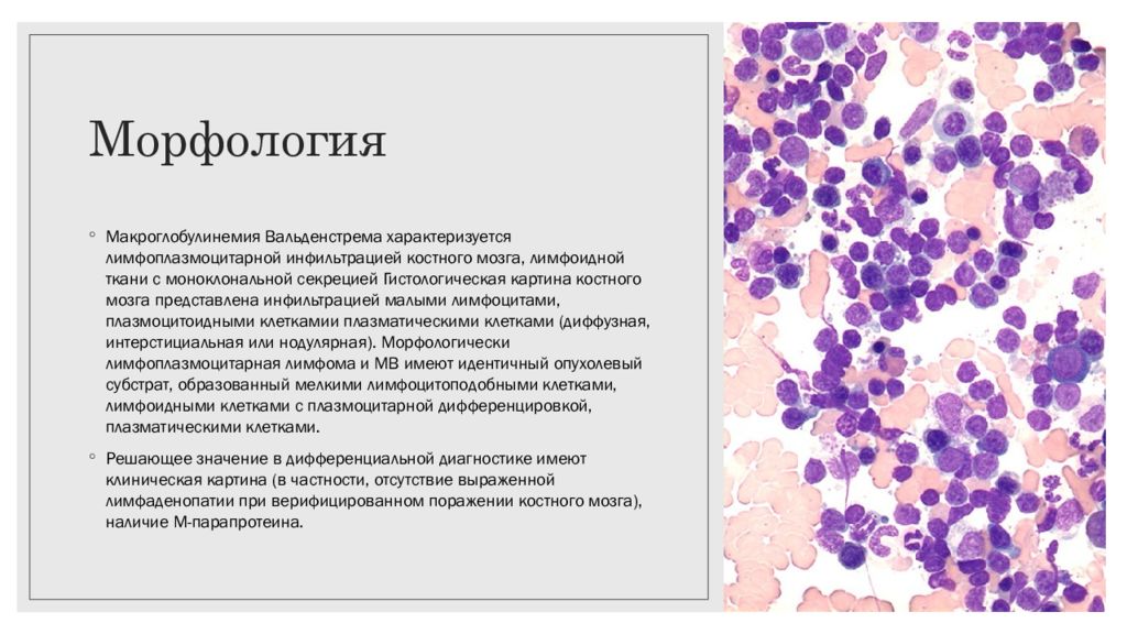 Морф логия. Лимфоидная инфильтрация гистология. Макроглобулинемия Вальденстрема. Макроглобулинемия Вальденстрема костный мозг. Макроглобулинемия Вальденстрема костный мозг гистология.