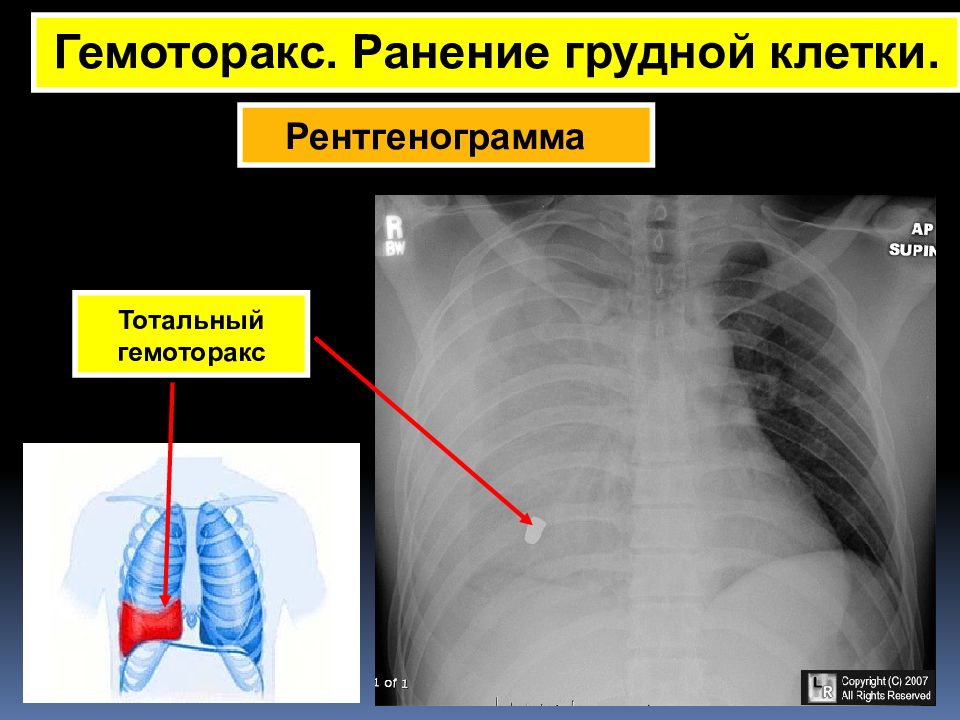 Гемоторакс клиническая картина