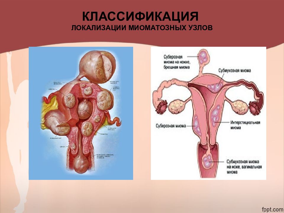 Злокачественные опухоли женских половых органов презентация