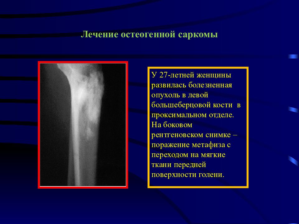 Опухоли костей и мягких тканей презентация