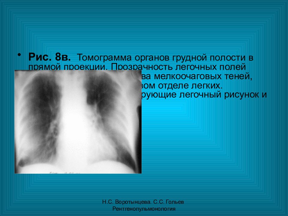 Легочное поле повышенной прозрачности. Кт синдром диссеминации. Прозрачность легочных полей. Синдром легочной диссеминации. Снижение прозрачности легочных полей.