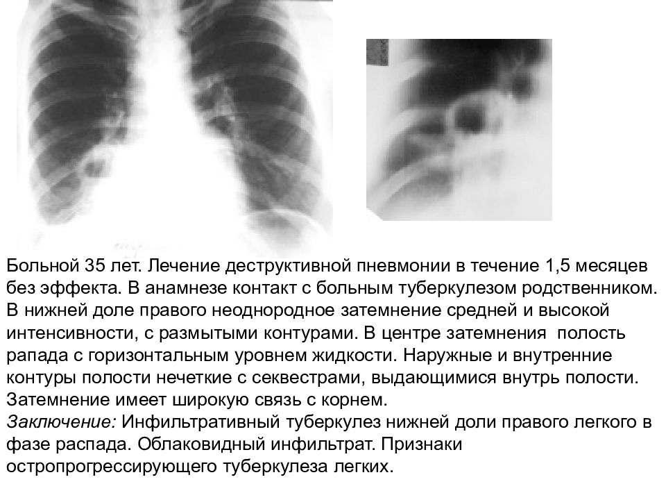 Деструктивная пневмония. Что такое деструктивная пневмония s6. Острая деструктивная пневмония у детей рентген. Рентген острой деструктивной пневмонии. Деструктивная пневмония рентген описание.