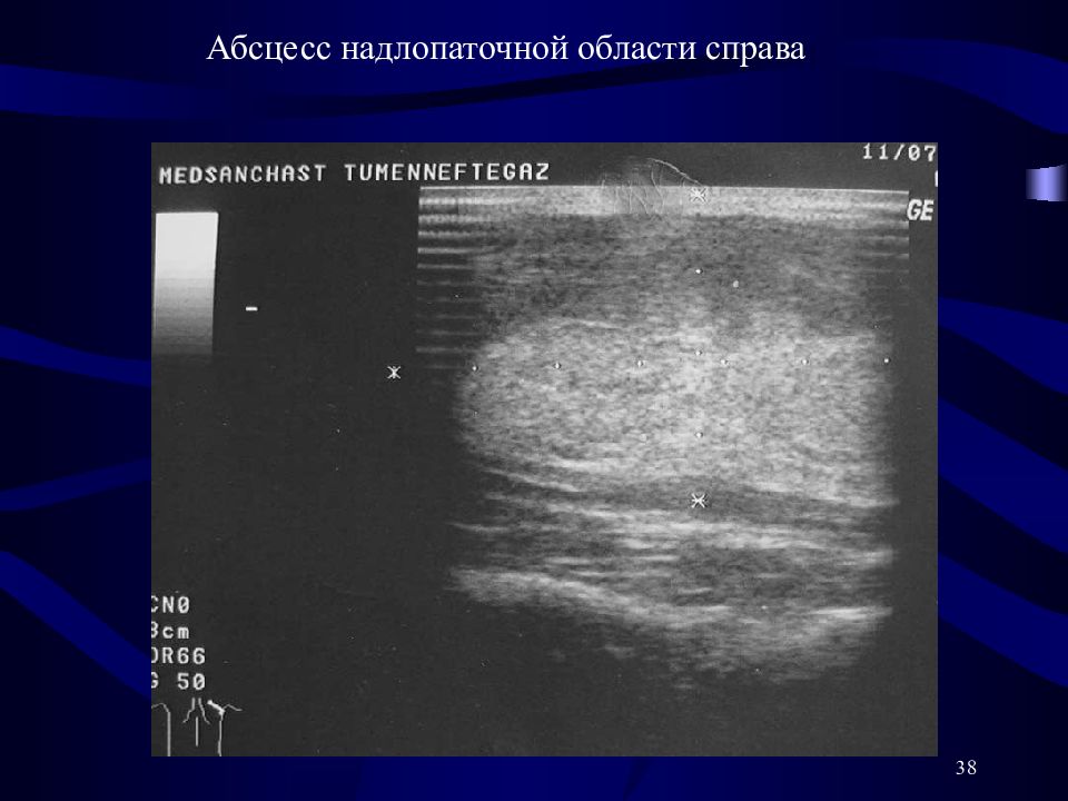 Абсцесс брюшной полости презентация