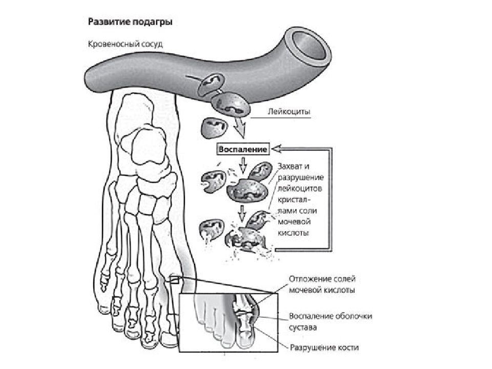 Подагра патогенез схема