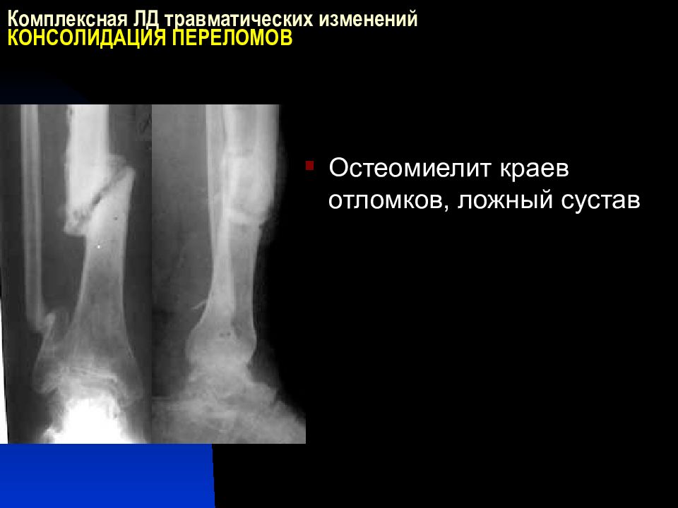 Консолидация перелома. Ложный сустав после остеомиелита. Ложный сустав рентгенодиагностика. Костно травматические изменения. Травматический остеомиелит.