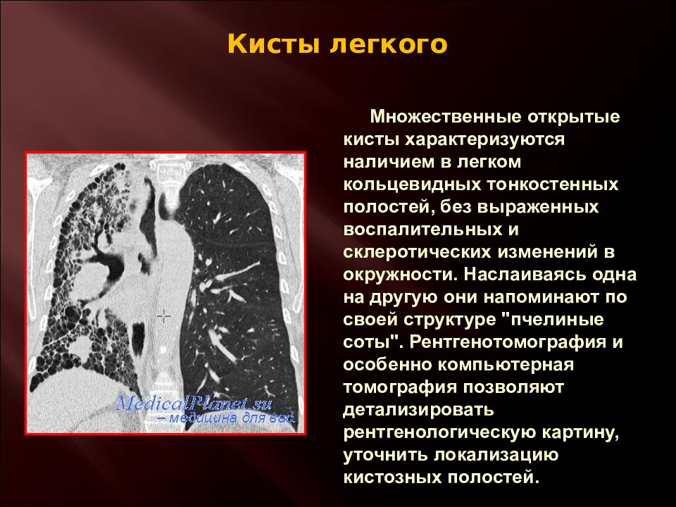 Киста легкого. Множественные кисты легких. Множественные ретенционные кисты легких. Множественные тонкостенные полости в легких. Тонкостенные воздушные кисты в легких.