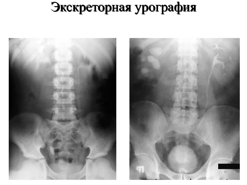 Экскреторная урография презентация