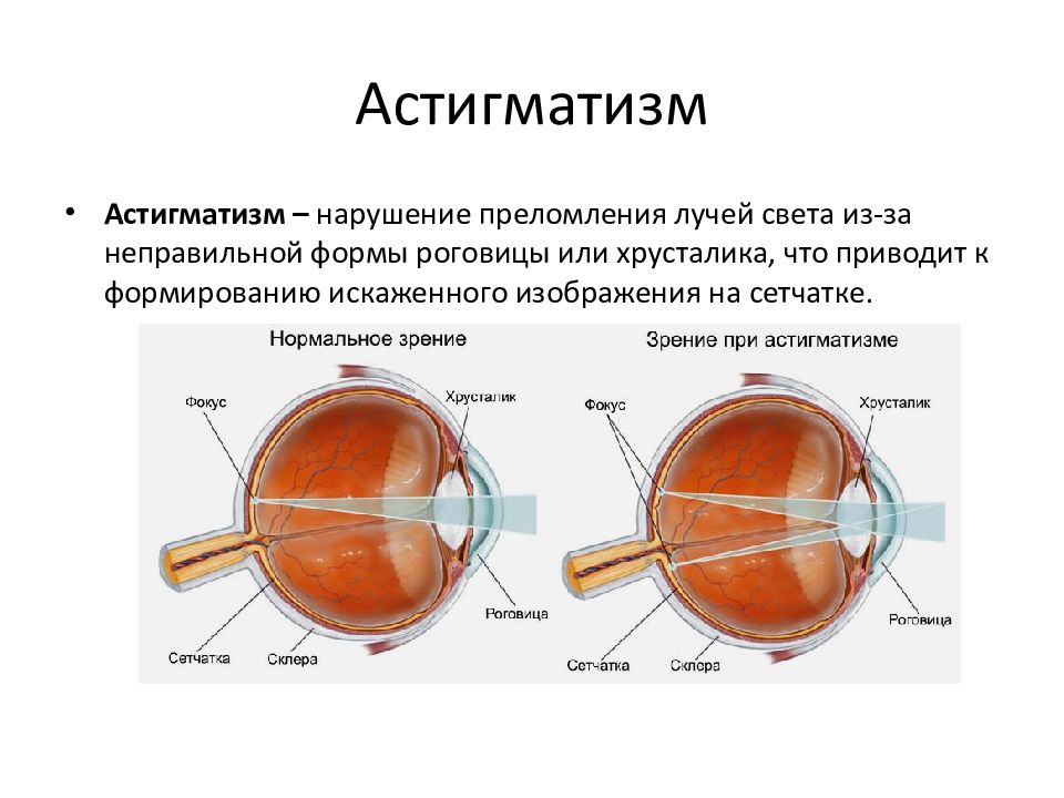 Изображение при астигматизме рассматриваемого предмета