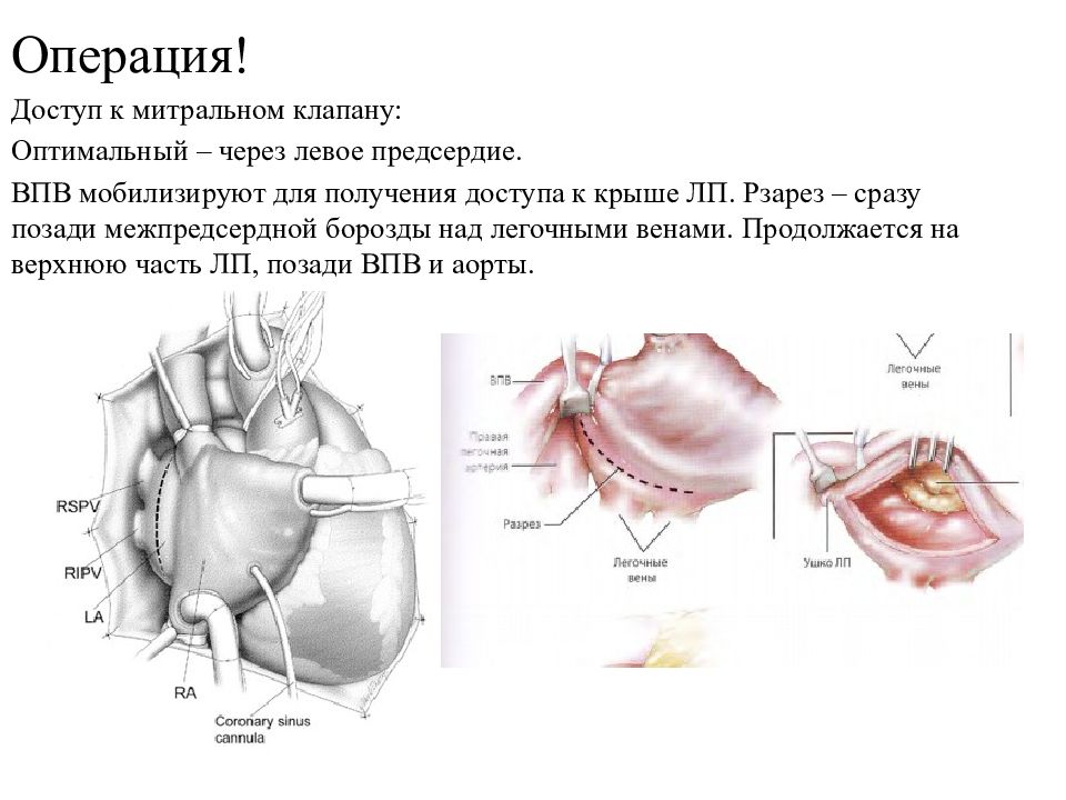 Операция сеннинга схема