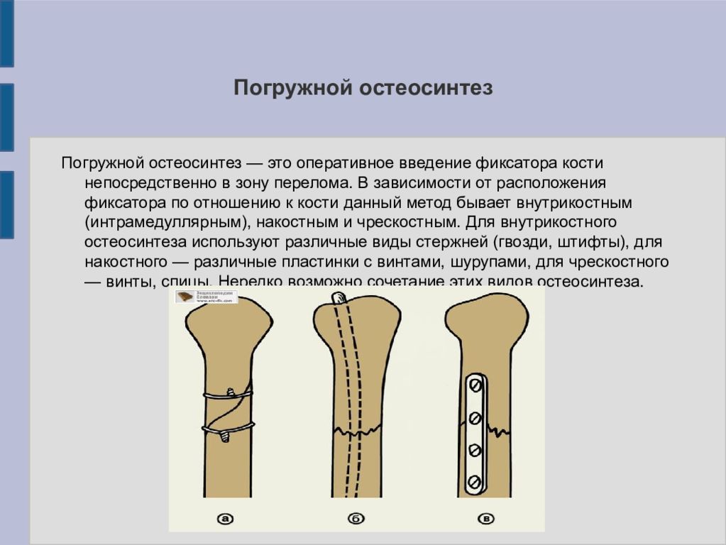 Остеосинтез это