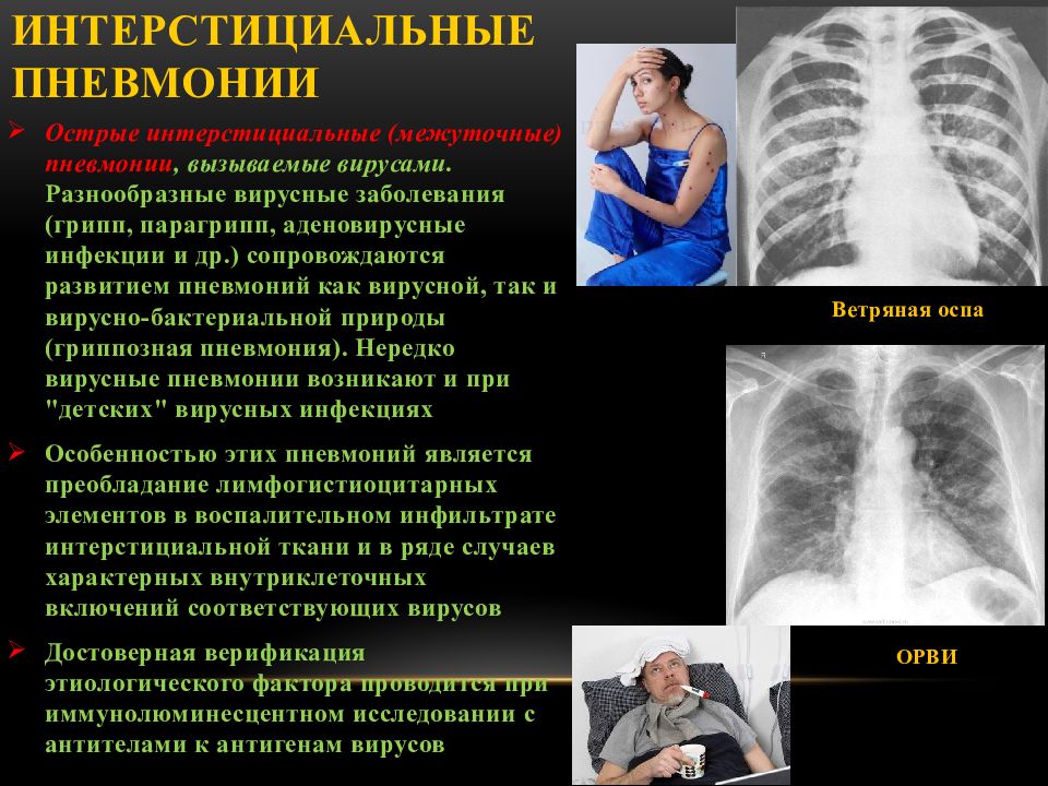 Презентация интерстициальные заболевания легких