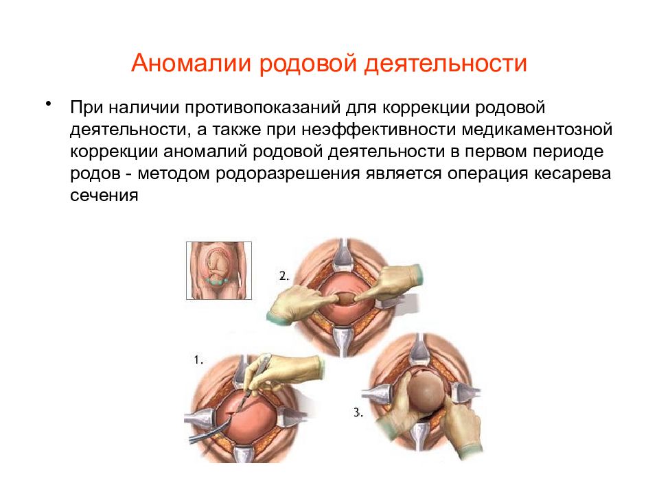 Аномалии родовой деятельности картинки