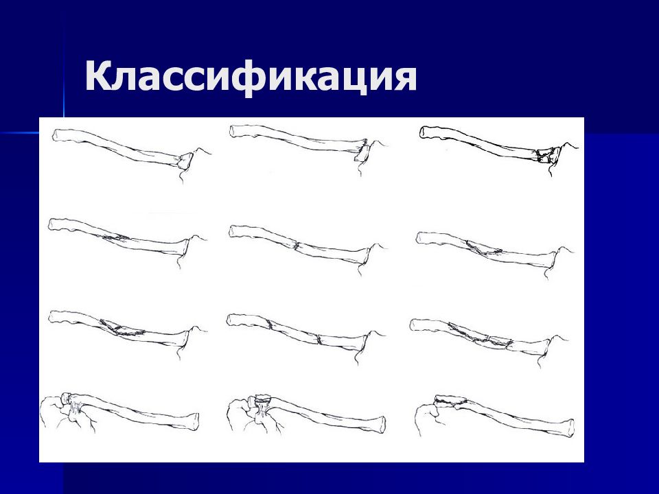 Классификация верхних конечностей. Пластика верхних конечностей