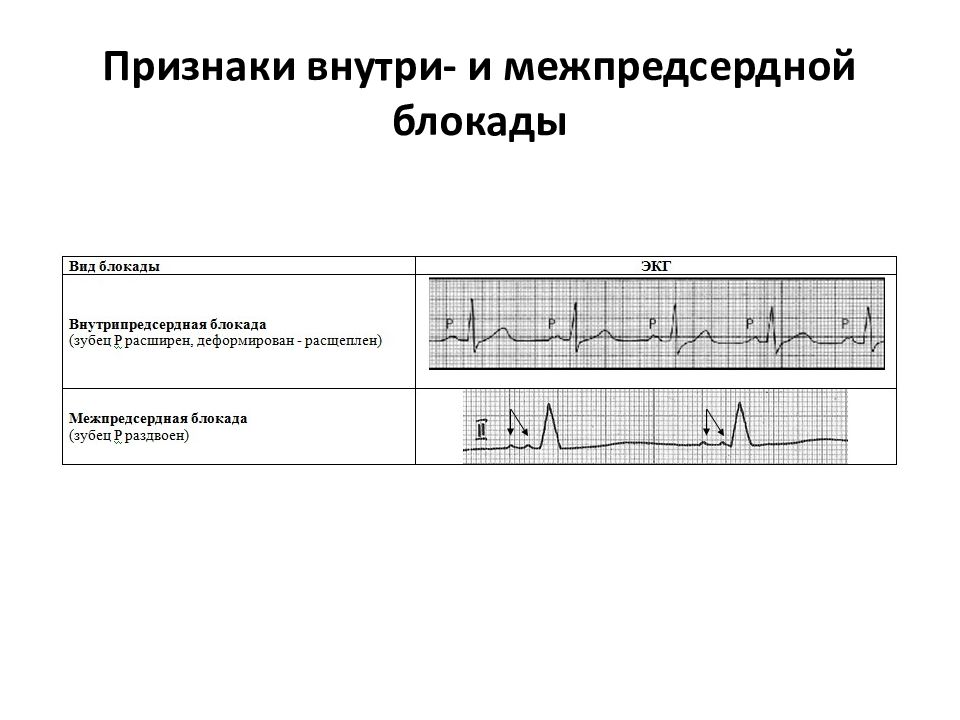 Экг блокады тест