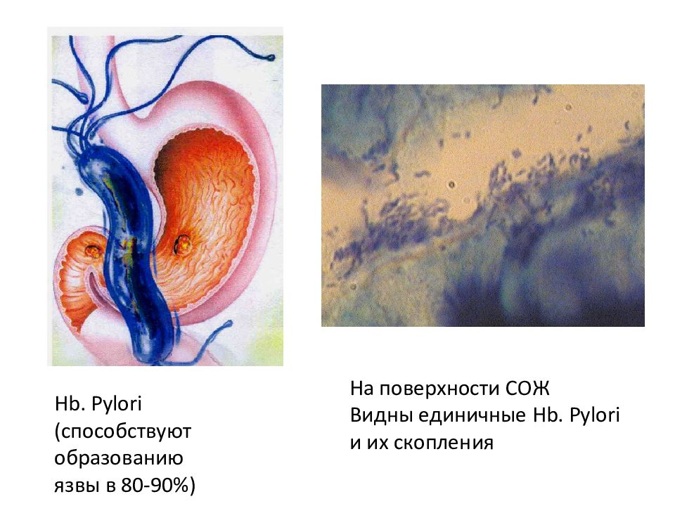 Послеродовая язва презентация