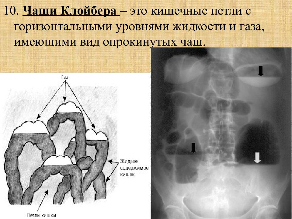 Единичный микроочаг. Рентген брюшной полости чаши Клойбера. Рентген кишечника чаши Клойбера. Чаши Клойбера при кишечной непроходимости. Кишечная непроходимость рентген чаши Клойбера.