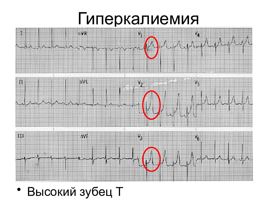 Экг при гиперкалиемии картинки