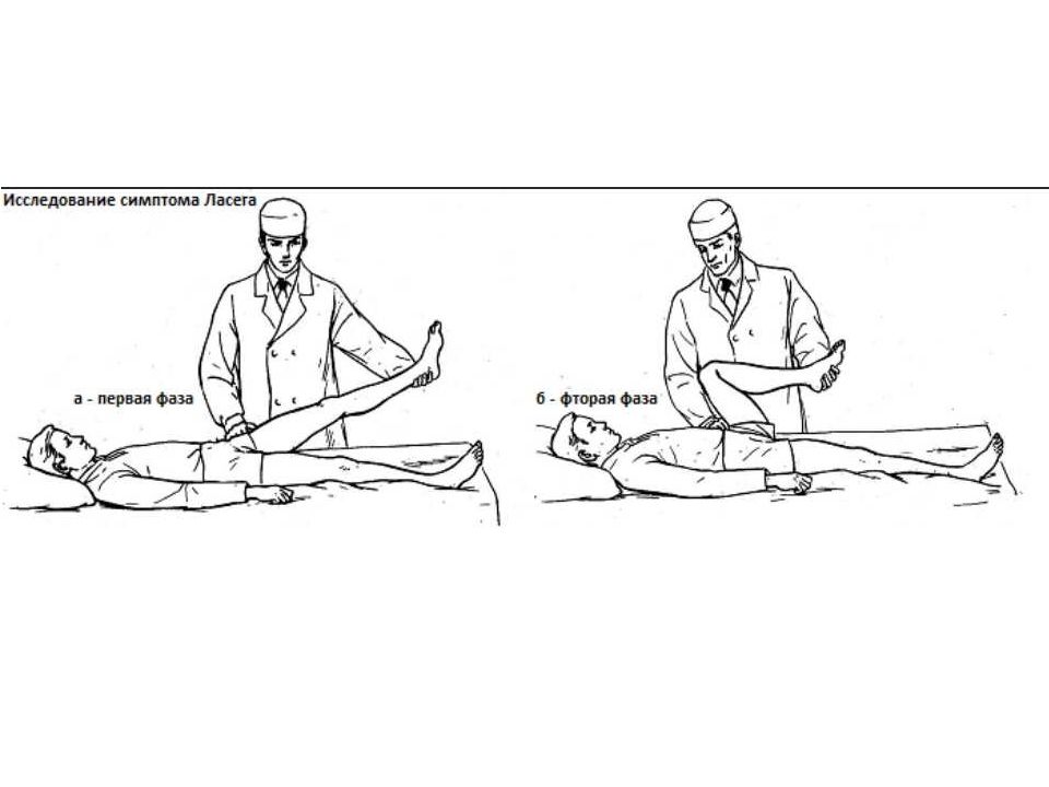 Симптом ласега положительный. Симптом натяжения Ласега. Перекрестный симптом Ласега. Положительный симптом Ласега.